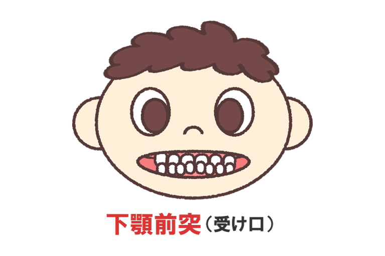 症例・反対咬合の早期治療例（Y君のケース）